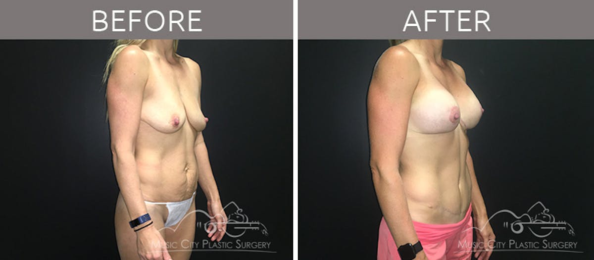 Breast Lift with Augmentation Before & After Gallery - Patient 132099626 - Image 4