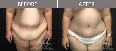 Abdominoplasty Before & After Gallery - Patient 90709143 - Image 2