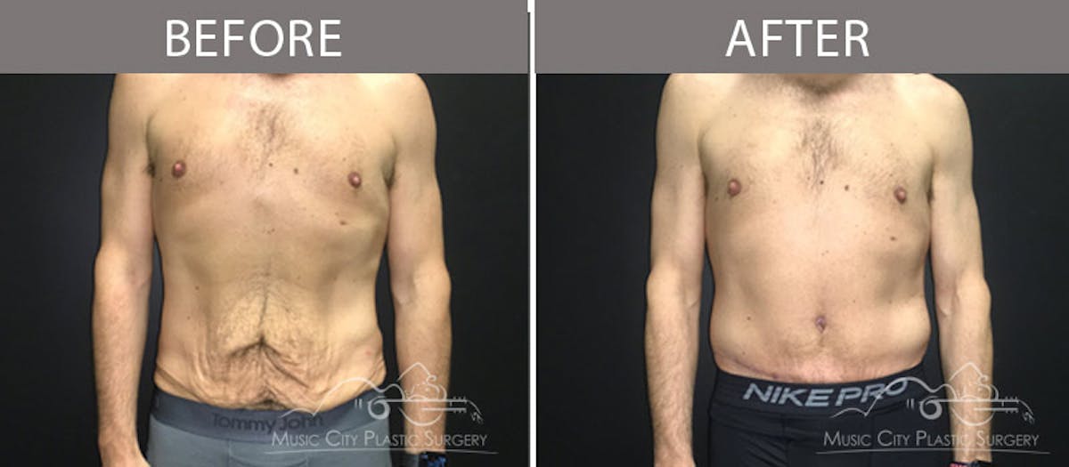 BodyLift Before & After Gallery - Patient 90709141 - Image 1