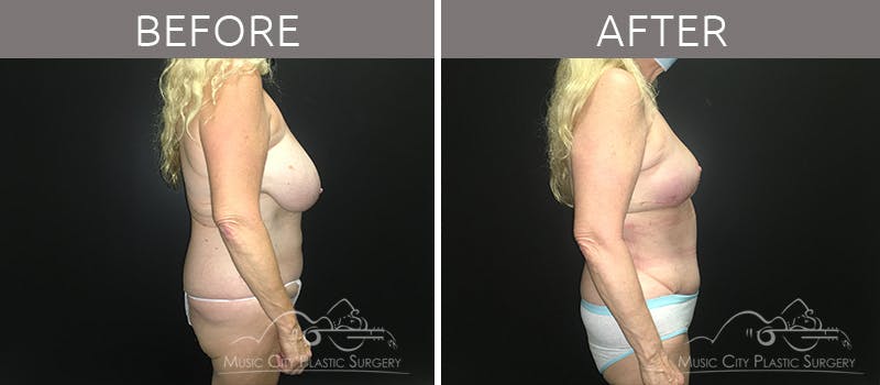 Mommy Makeover Before & After Gallery - Patient 90709142 - Image 5