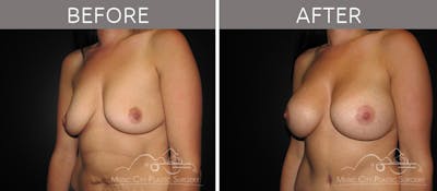 Breast Augmentation Before & After Gallery - Patient 90709145 - Image 2