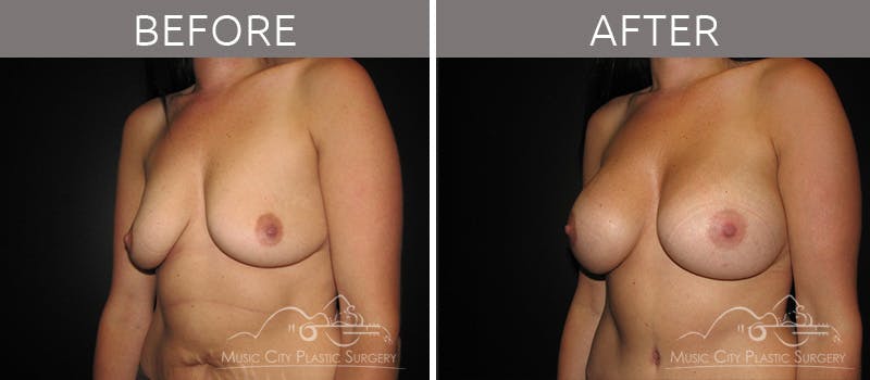 Breast Augmentation Before & After Gallery - Patient 90709145 - Image 1