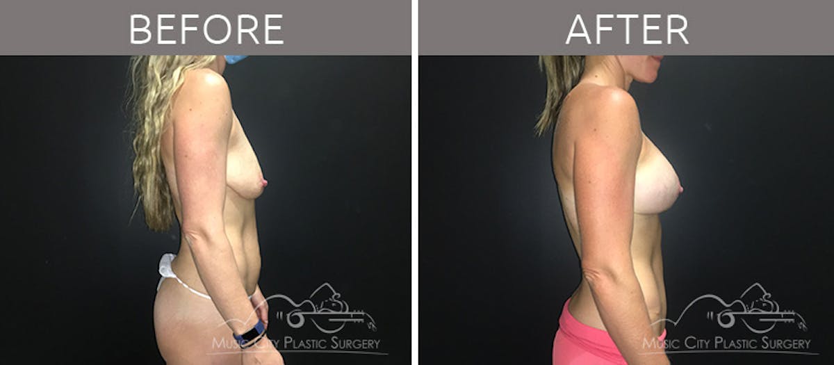 Breast Lift with Augmentation Before & After Gallery - Patient 132099626 - Image 5