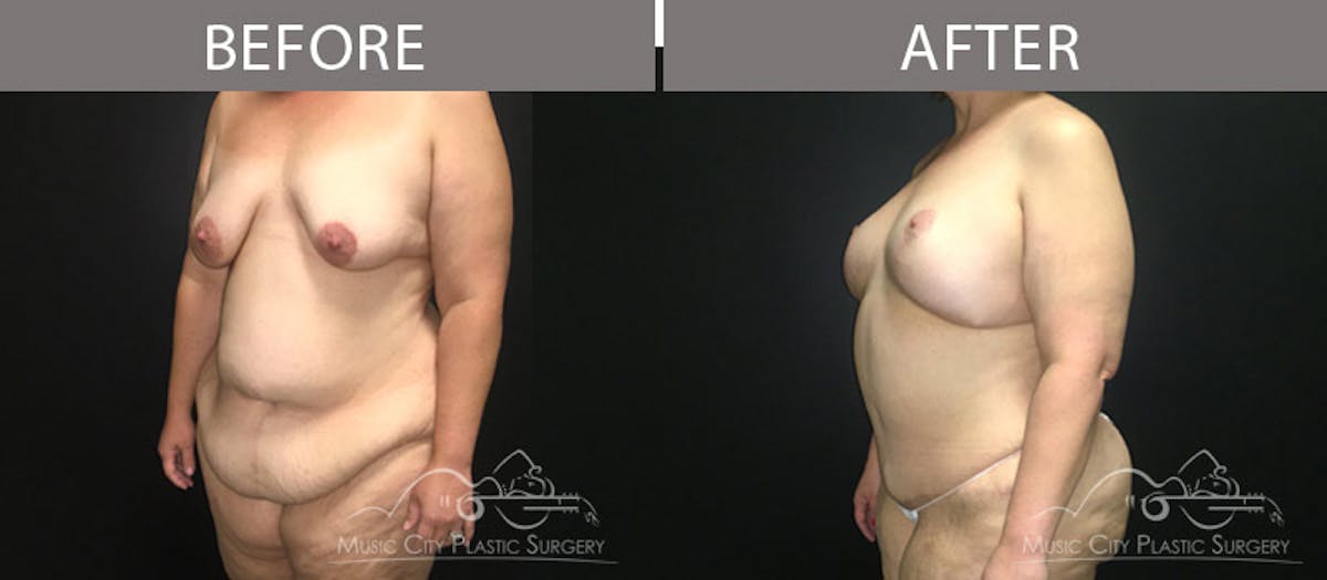 Abdominoplasty Before & After Gallery - Patient 90709143 - Image 2