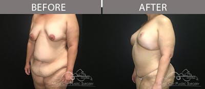 Abdominoplasty Before & After Gallery - Patient 90709143 - Image 2