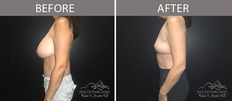 Capsulectomy Before & After Gallery - Patient 90709148 - Image 3