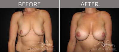 Breast Augmentation Before & After Gallery - Patient 90709145 - Image 1