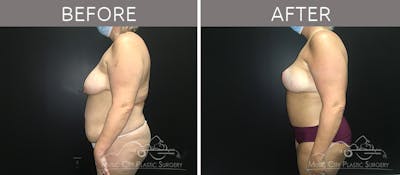 Mommy Makeover Before & After Gallery - Patient 90709156 - Image 3