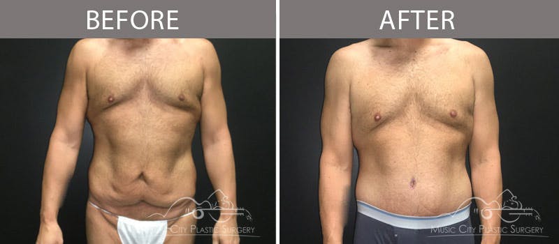 Belt Lipectomy/BodyLift Before & After Gallery - Patient 90709149 - Image 1