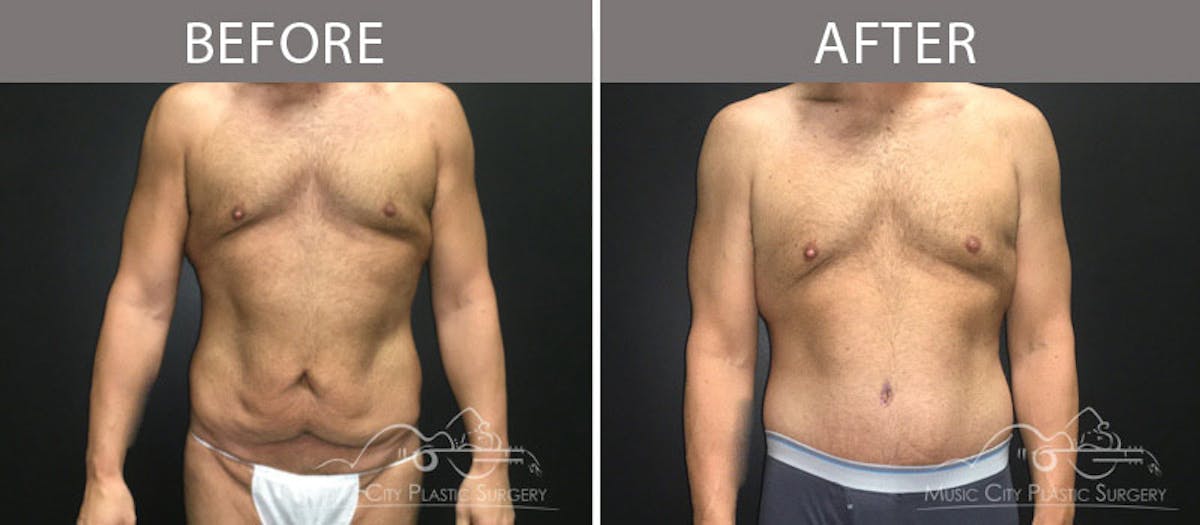 BodyLift Before & After Gallery - Patient 90709149 - Image 1