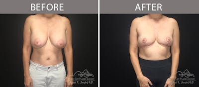 Capsulectomy Before & After Gallery - Patient 90709148 - Image 1