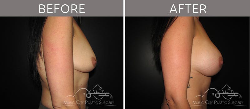 Breast Augmentation Before & After Gallery - Patient 90709145 - Image 3