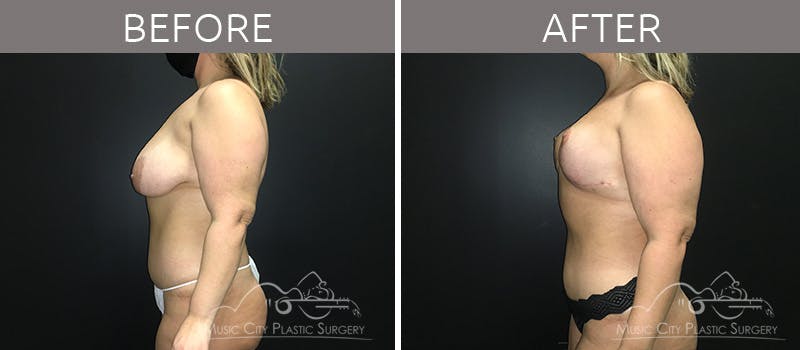 Breast Lift Before & After Gallery - Patient 90709161 - Image 3