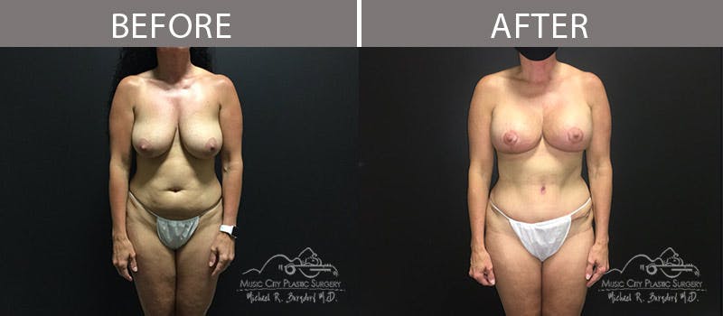 Abdominoplasty Before & After Gallery - Patient 90709146 - Image 1