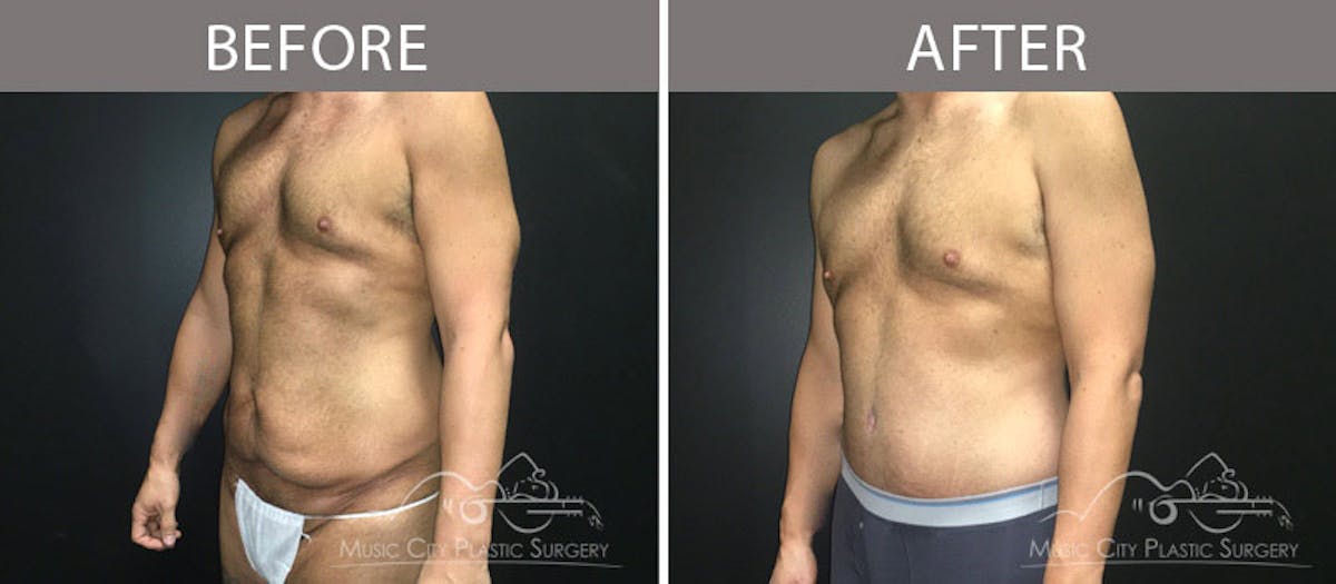 BodyLift Before & After Gallery - Patient 90709149 - Image 2
