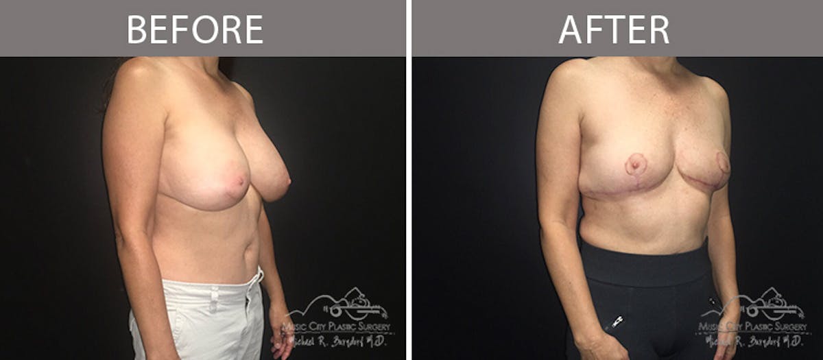 Capsulectomy Before & After Gallery - Patient 90709148 - Image 2