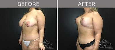 Breast Lift Before & After Gallery - Patient 90709161 - Image 2
