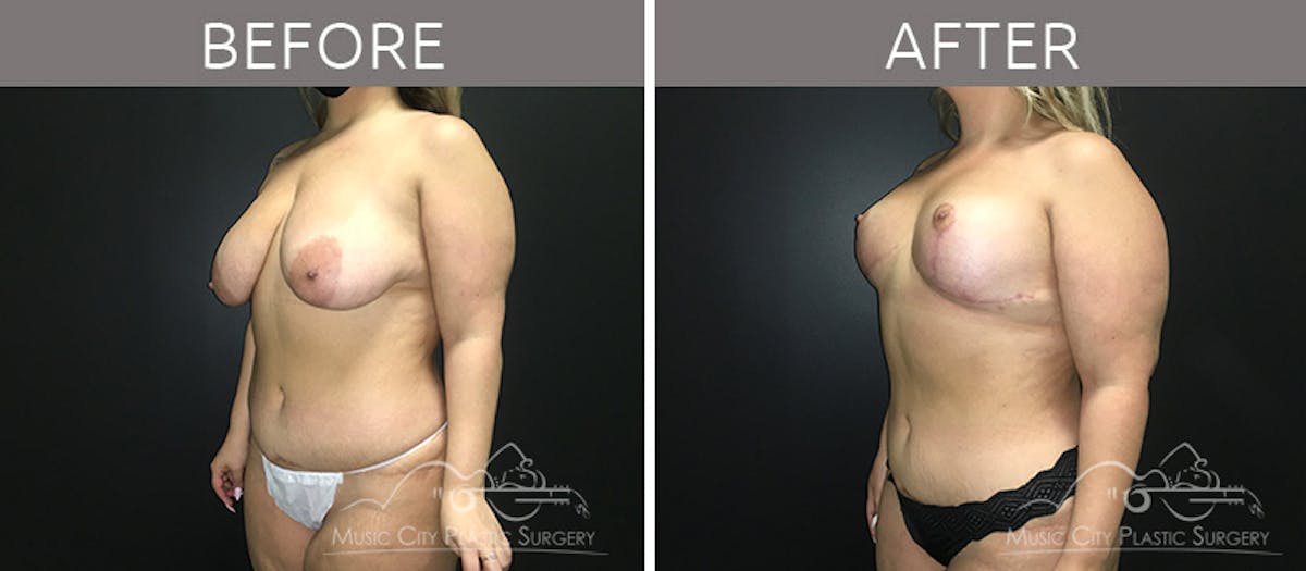 Breast Lift Before & After Gallery - Patient 90709161 - Image 2