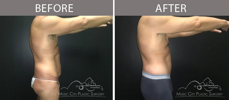 Belt Lipectomy/BodyLift Before & After Gallery - Patient 90709149 - Image 3