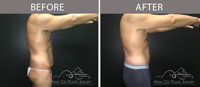 Belt Lipectomy/BodyLift Before & After Gallery - Patient 90709149 - Image 3