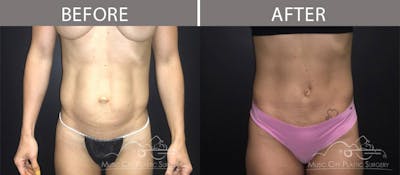 Abdominoplasty Before & After Gallery - Patient 90709155 - Image 1