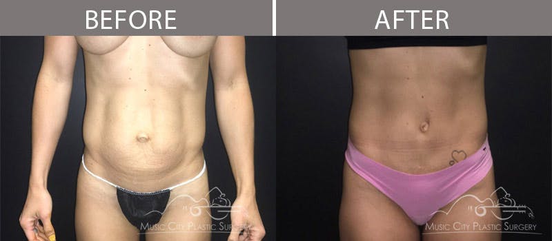 Abdominoplasty Before & After Gallery - Patient 90709155 - Image 1