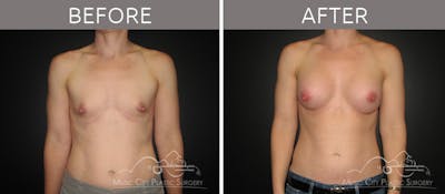 Breast Augmentation Before & After Gallery - Patient 90709158 - Image 1