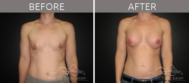 Breast Augmentation Before & After Gallery - Patient 90709158 - Image 1