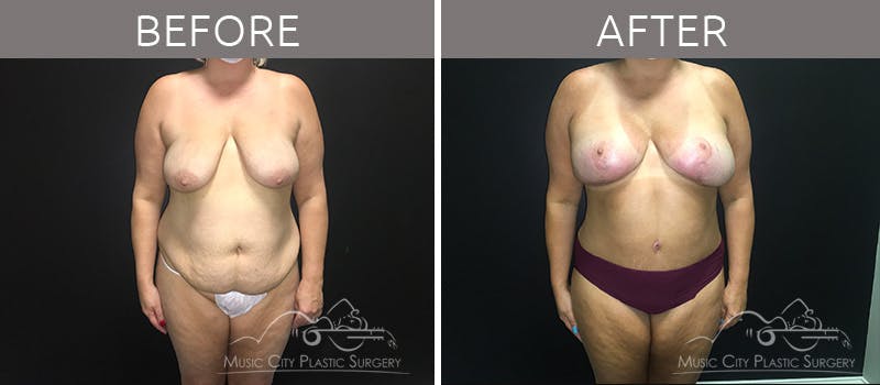 Mommy Makeover Before & After Gallery - Patient 90709156 - Image 3