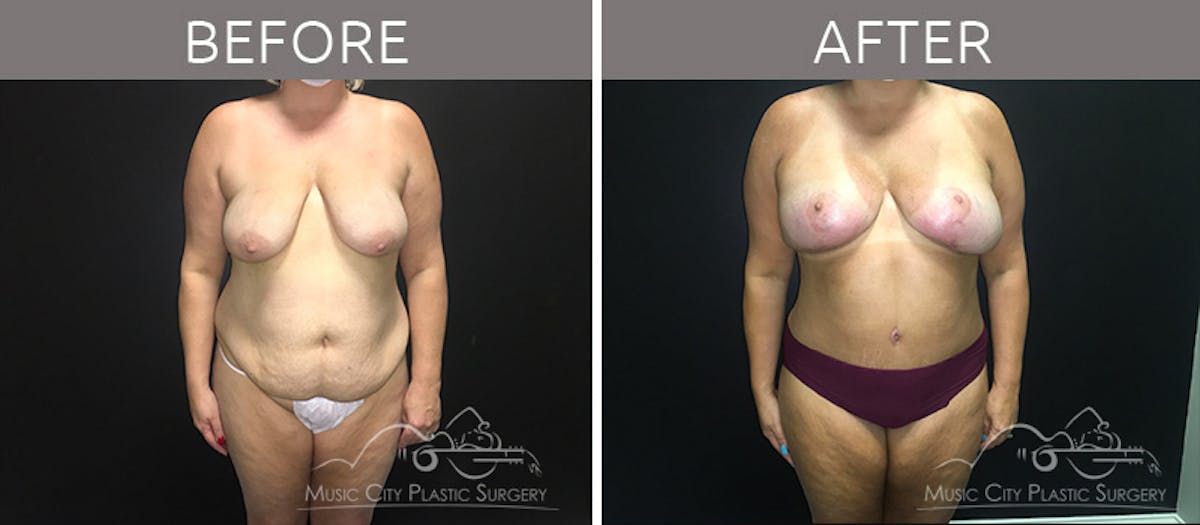 Mommy Makeover Before & After Gallery - Patient 90709156 - Image 1
