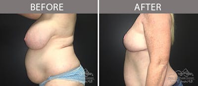 Capsulectomy Before & After Gallery - Patient 90709163 - Image 3