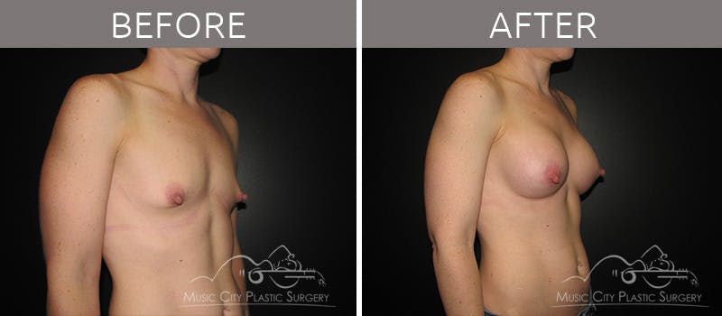Breast Augmentation Before & After Gallery - Patient 90709158 - Image 2