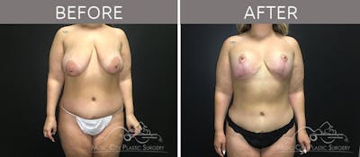 Breast Lift Before & After Gallery - Patient 90709161 - Image 1