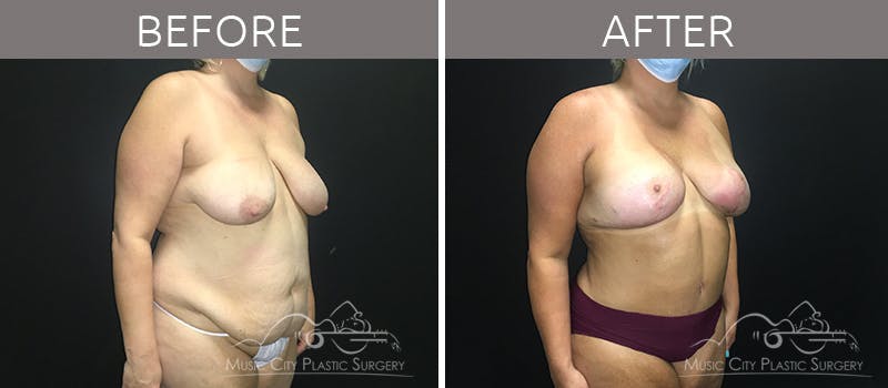 Mommy Makeover Before & After Gallery - Patient 90709156 - Image 4