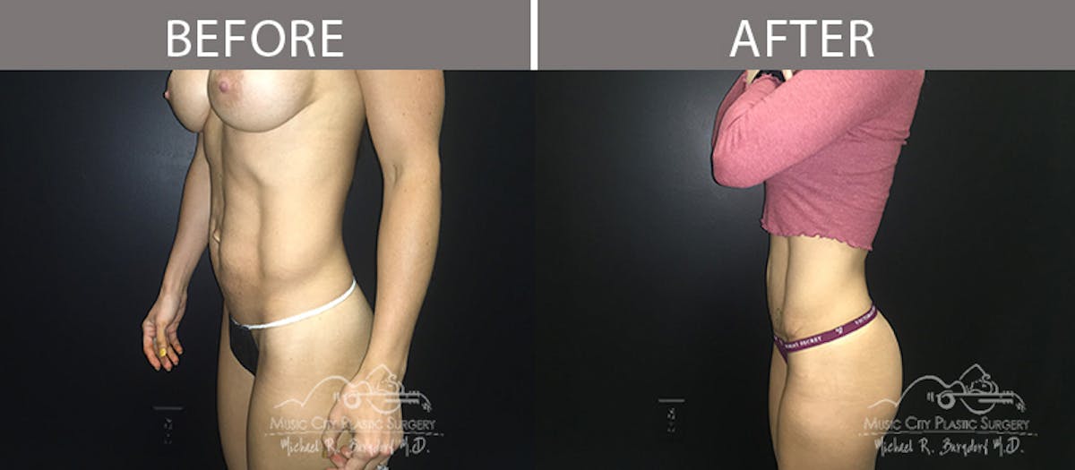 Abdominoplasty Before & After Gallery - Patient 90709155 - Image 2