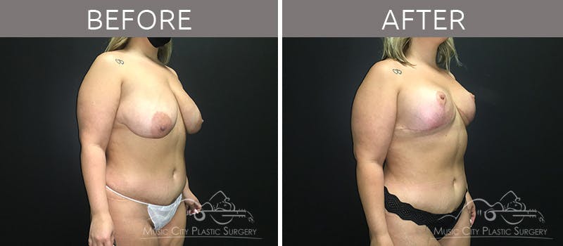 Breast Lift Before & After Gallery - Patient 90709161 - Image 4