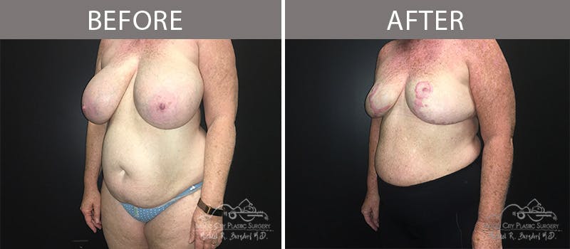 Capsulectomy Before & After Gallery - Patient 90709163 - Image 2