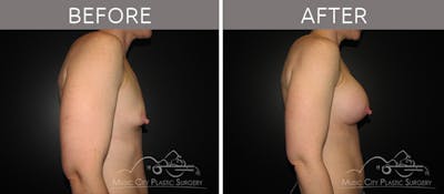 Breast Augmentation Before & After Gallery - Patient 90709158 - Image 3