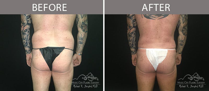 Brazilian Butt Lift Before & After Gallery - Patient 90709164 - Image 2
