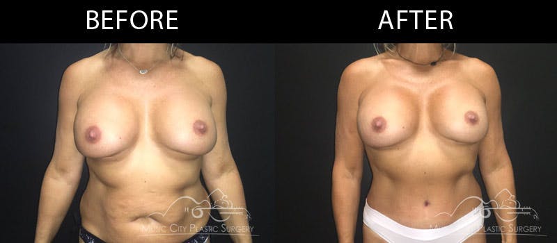 Abdominoplasty Before & After Gallery - Patient 90709162 - Image 1