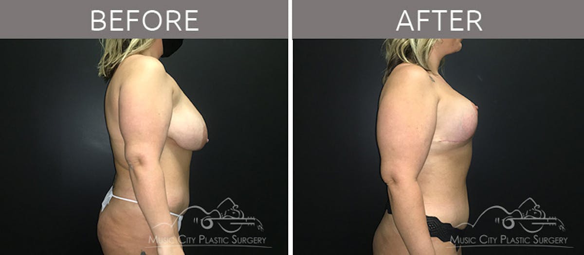 Breast Lift Before & After Gallery - Patient 90709161 - Image 5