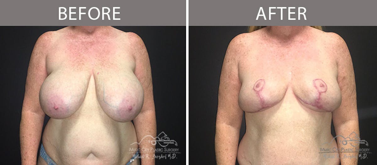 Capsulectomy Before & After Gallery - Patient 90709163 - Image 1