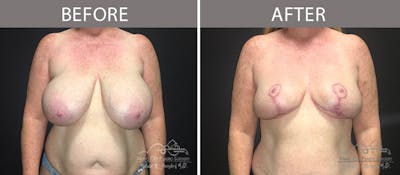 Capsulectomy Before & After Gallery - Patient 90709163 - Image 1