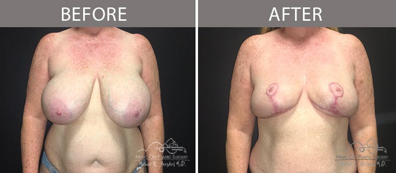 Capsulectomy Before & After Gallery - Patient 90709163 - Image 3