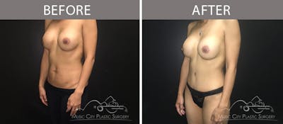 Mommy Makeover Before & After Gallery - Patient 90709166 - Image 2