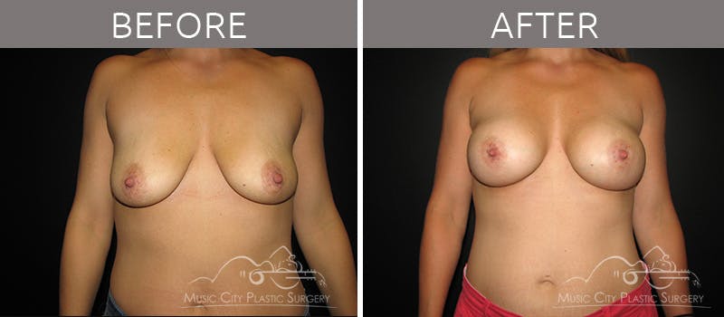 Breast Augmentation Before & After Gallery - Patient 90709165 - Image 1