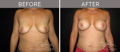 Breast Augmentation Before & After Gallery - Patient 90709165 - Image 1