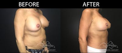 Abdominoplasty Before & After Gallery - Patient 90709162 - Image 2
