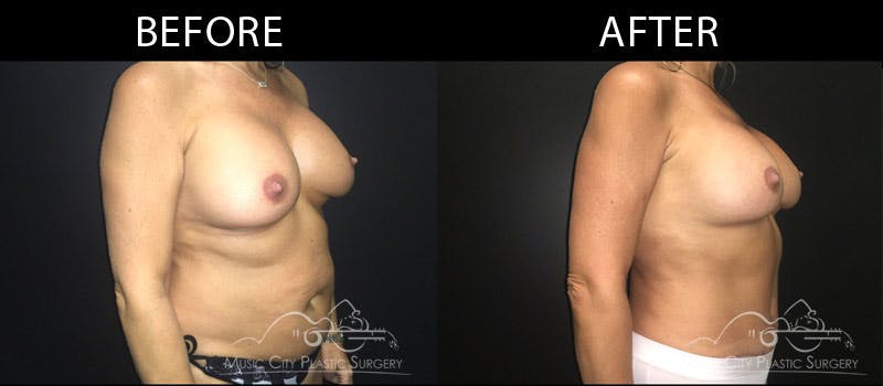 Abdominoplasty Before & After Gallery - Patient 90709162 - Image 2