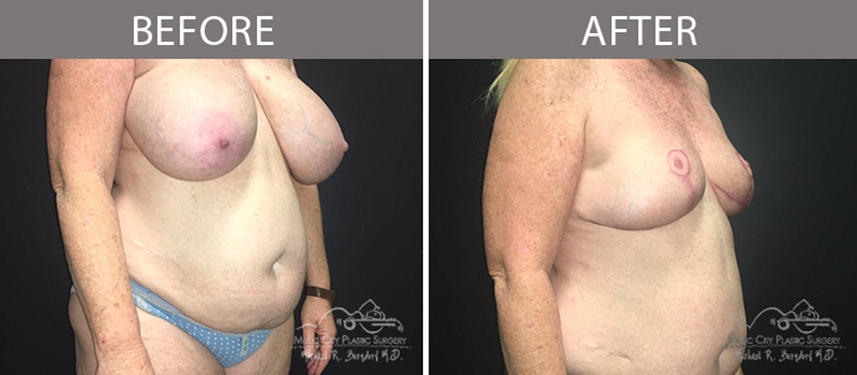 Capsulectomy Before & After Gallery - Patient 90709163 - Image 4